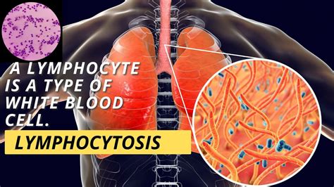 Lymphocytosis: Definition, Causes, Symptoms & Treatment.
